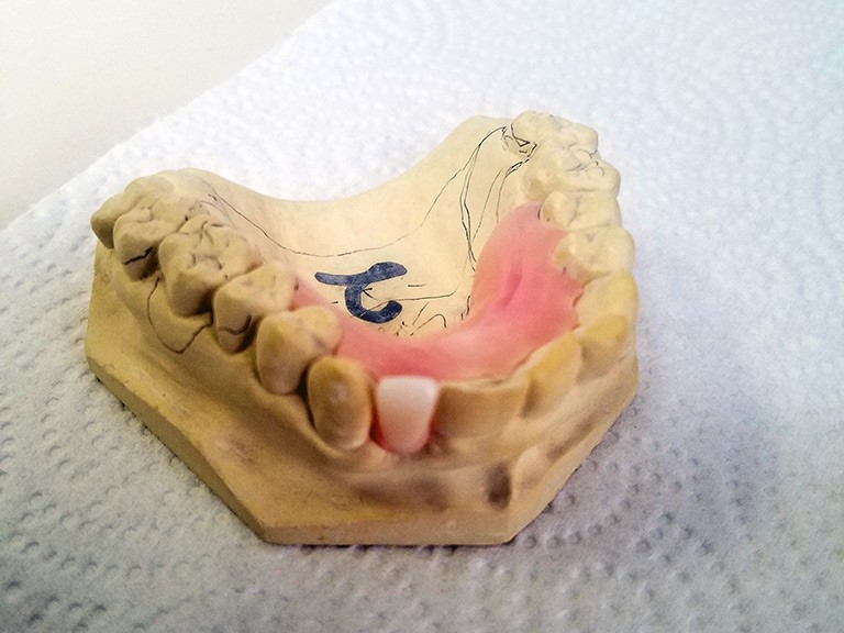 Jaw Registration For Complete Dentures Chesapeake VA 23324